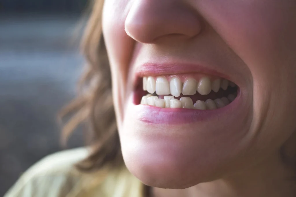 Lady with crooked teeth needs Porcelain veneers Harrison NY
