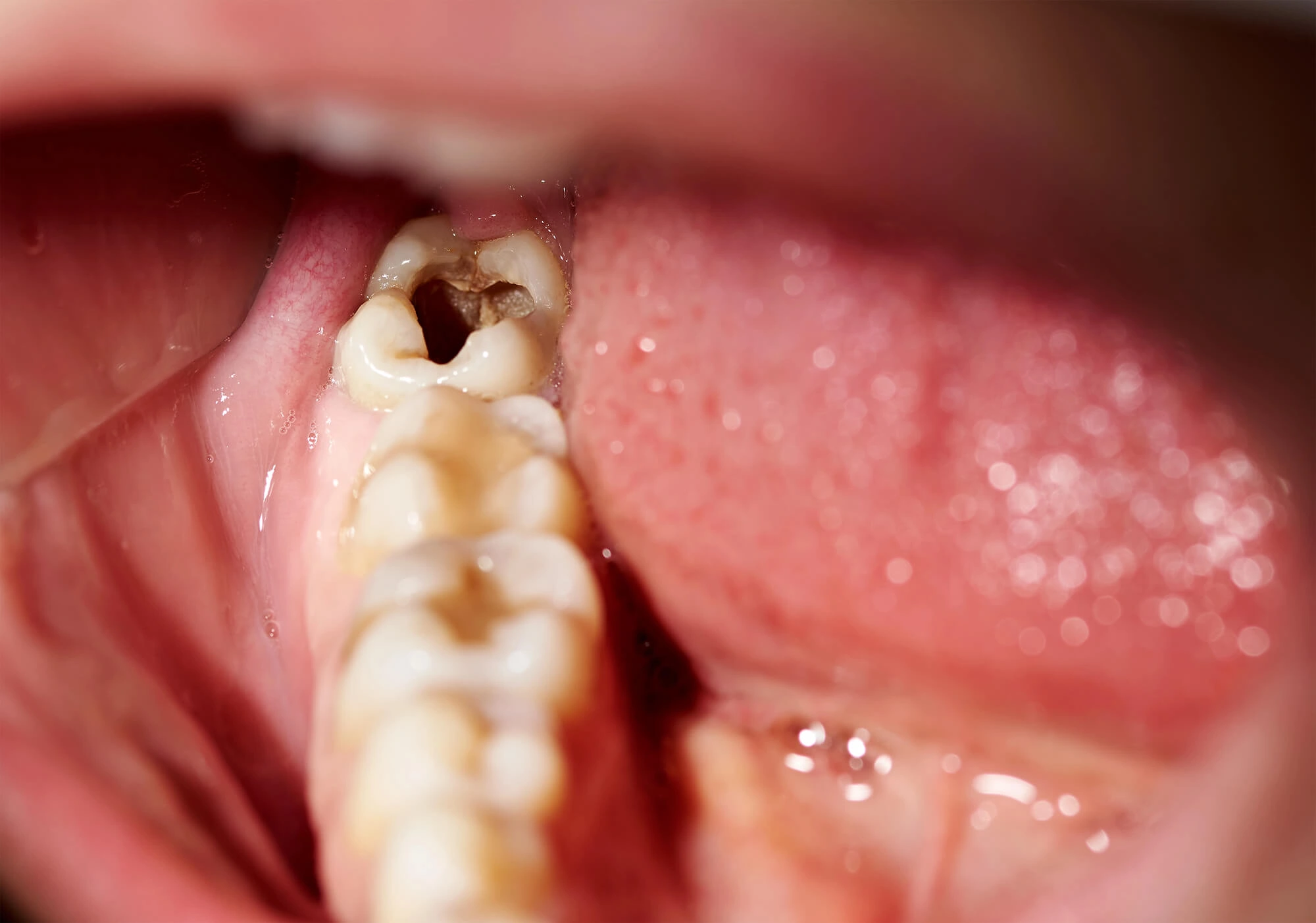 Tooth decay needs Tooth extraction Mamaroneck NY