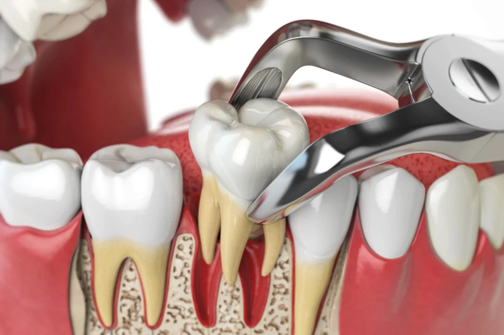 Tooth extraction Mamaroneck NY illustration