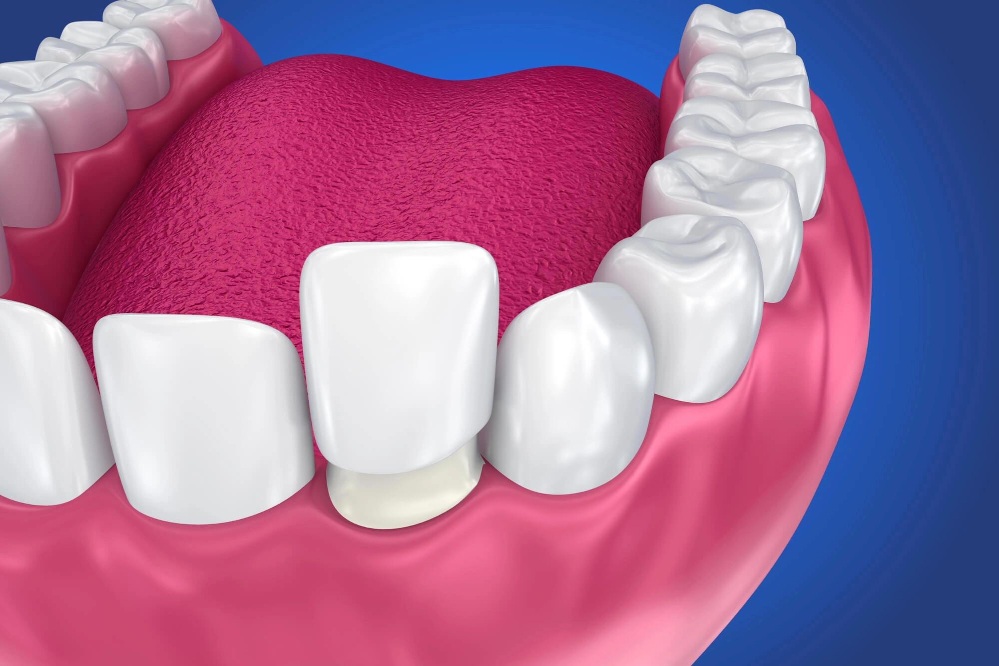 3D illustration of veneers by Dentist in Westchester NY