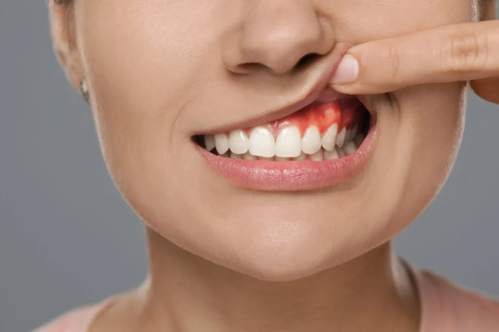 Swollen gums needs Dentist in Harrison NY