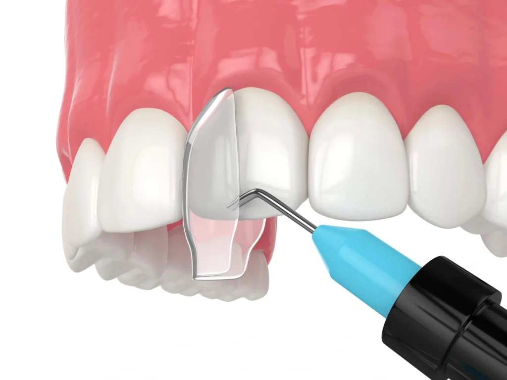 3D Illustration of bonding at Gentle Touch Dentistry