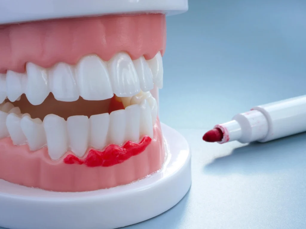 Gentle dentist Westchester NY gum model
