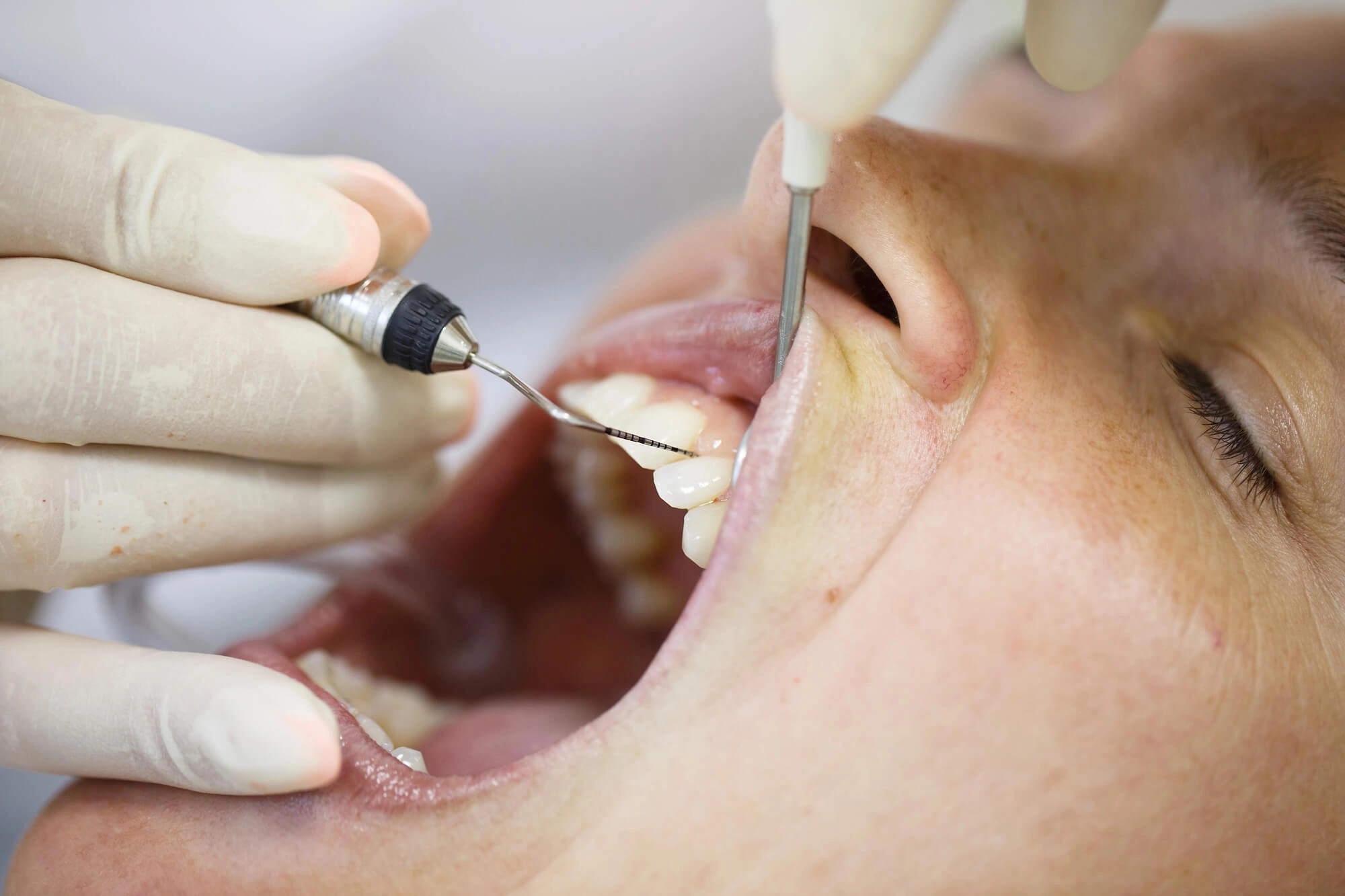 Undergoing gum treatment by Gentle dentist Westchester NY