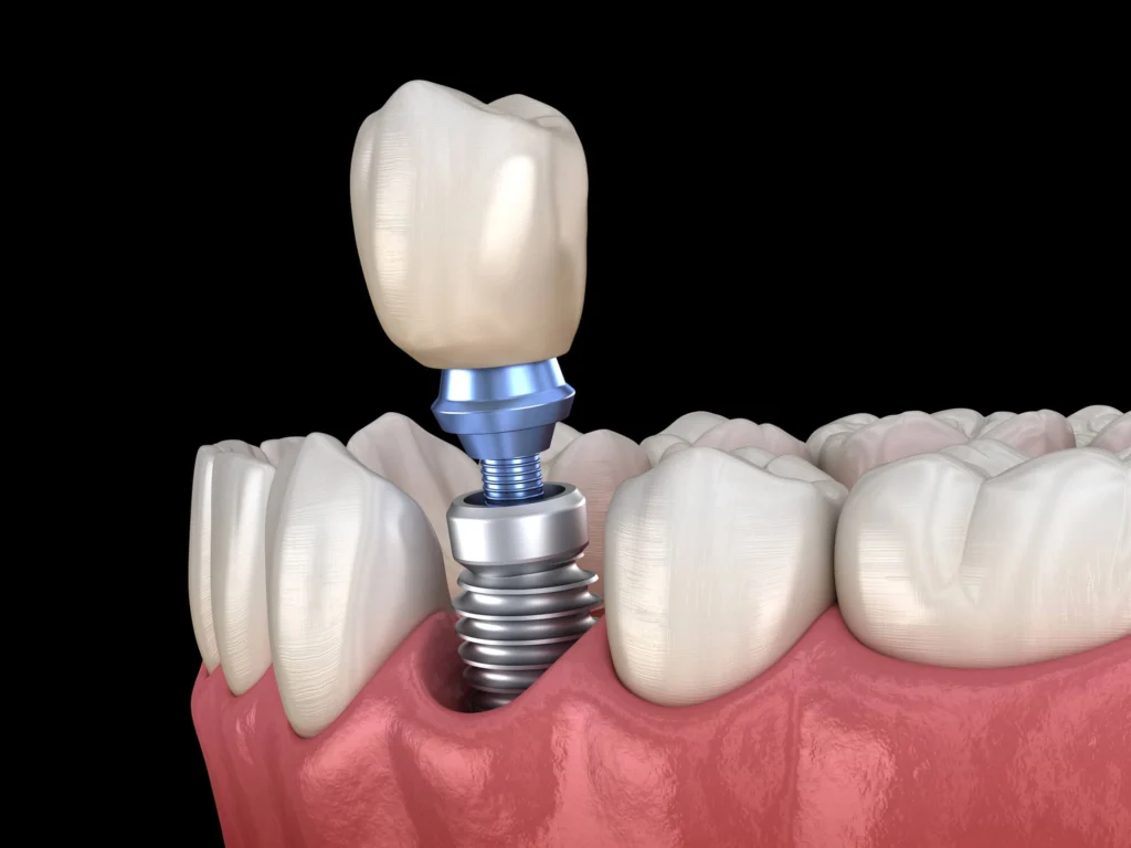 3D Illustration of Dental implants Harrison NY