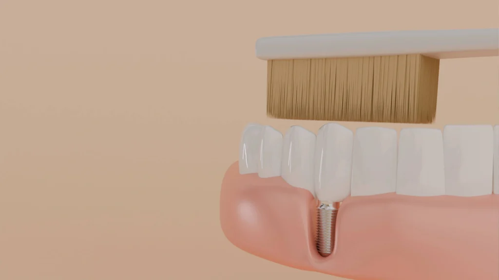 3D illustration of brushing Dental implants Mamaroneck NY