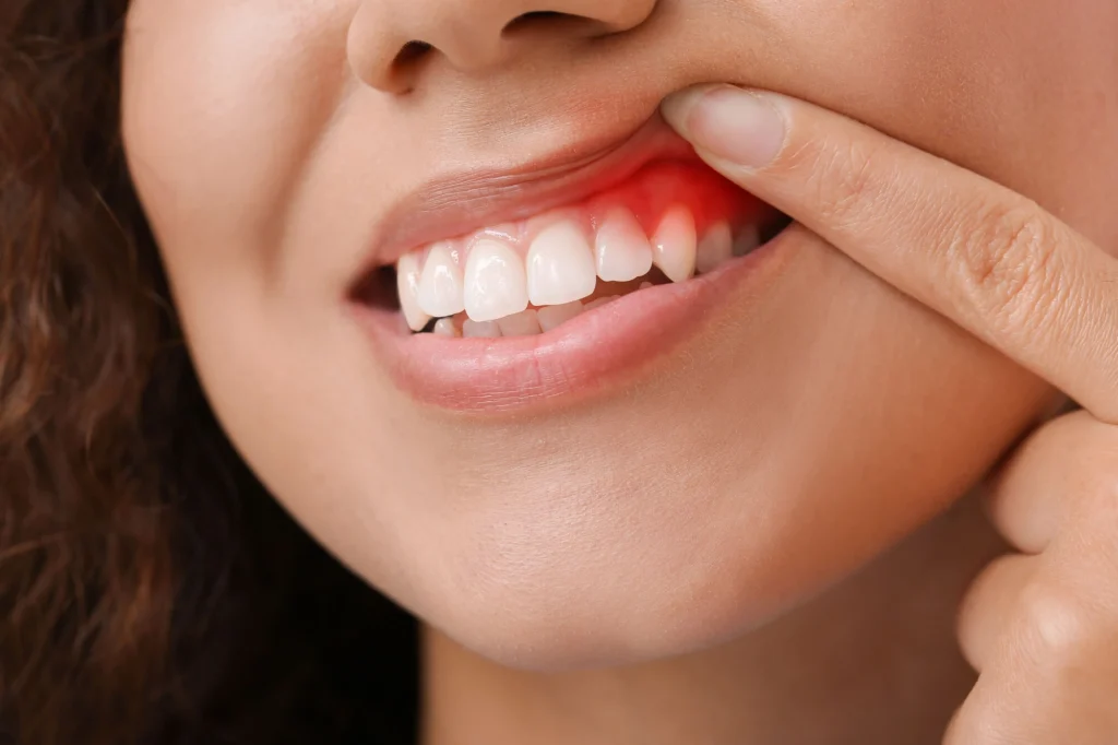 Girl with gum disease cant have Dental implants Harrison NY